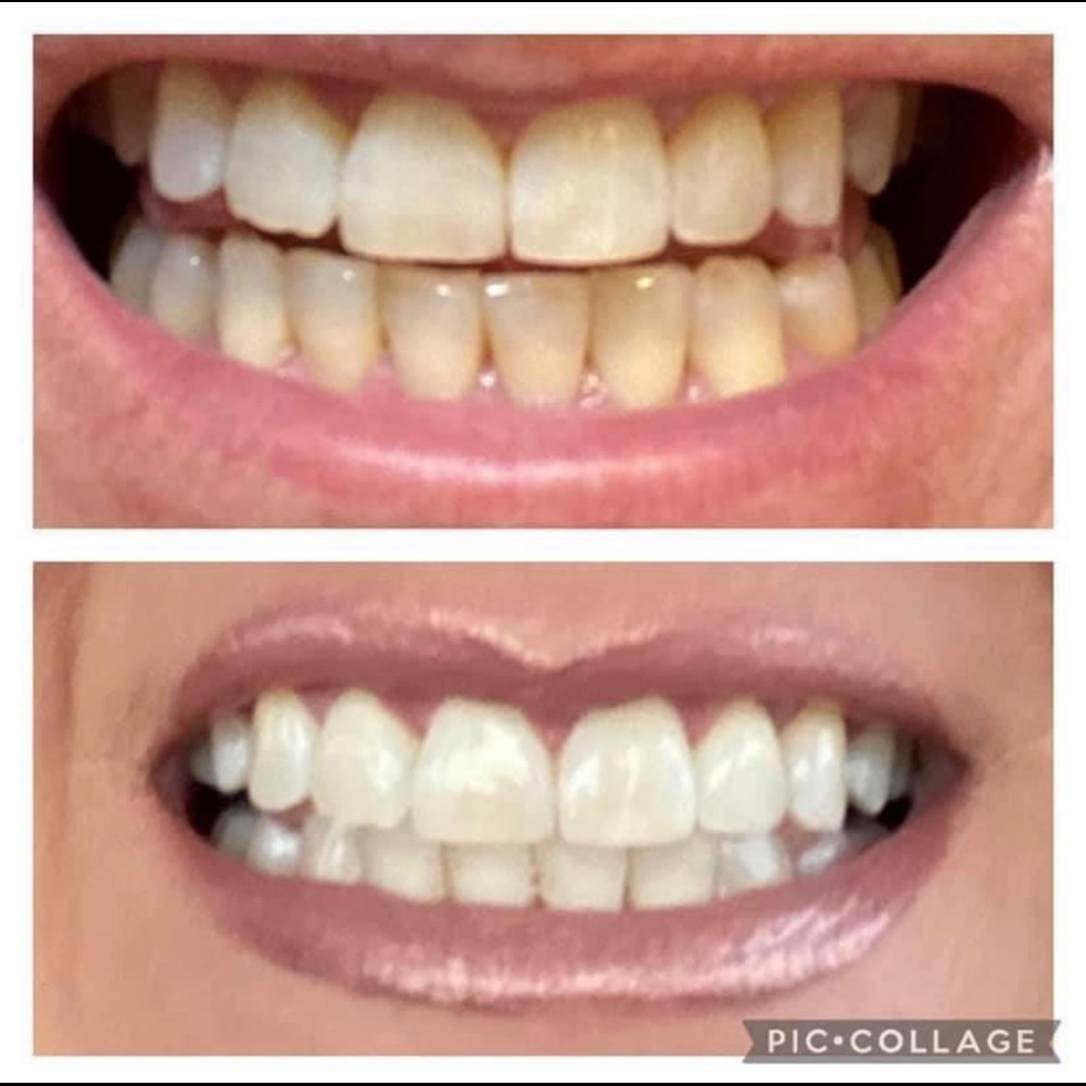 Whitening Toothpaste 🦷 - Picture 6 of 8